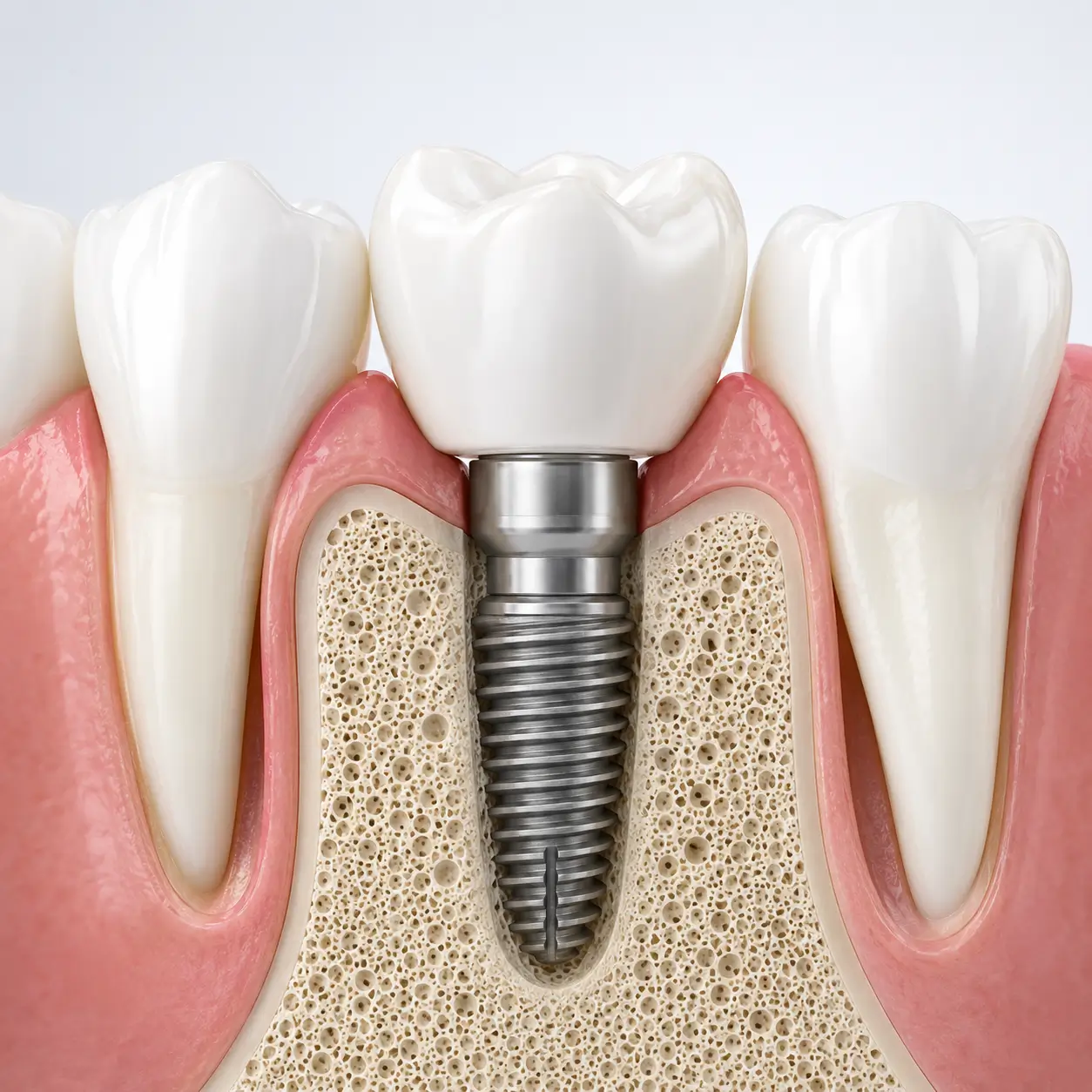 Dantų implantacija