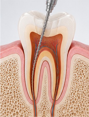 Dantų šaknų kanalų (endodontinis) gydymas