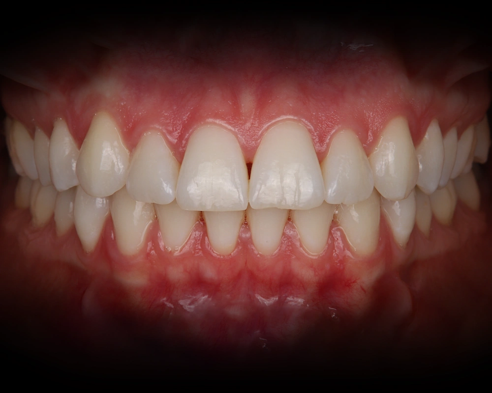 Balinimas-ZOOM-pries