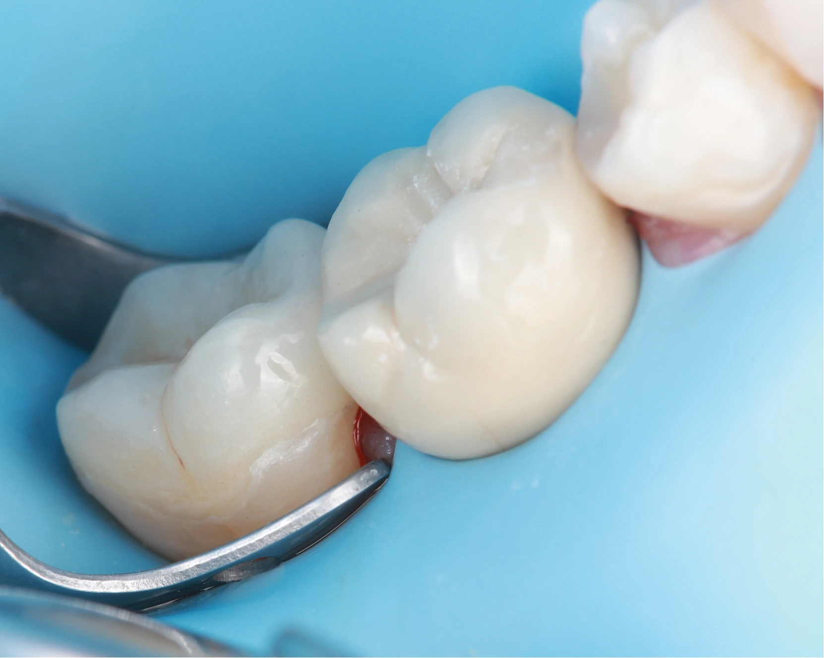 Keramikos-uzklotas-4