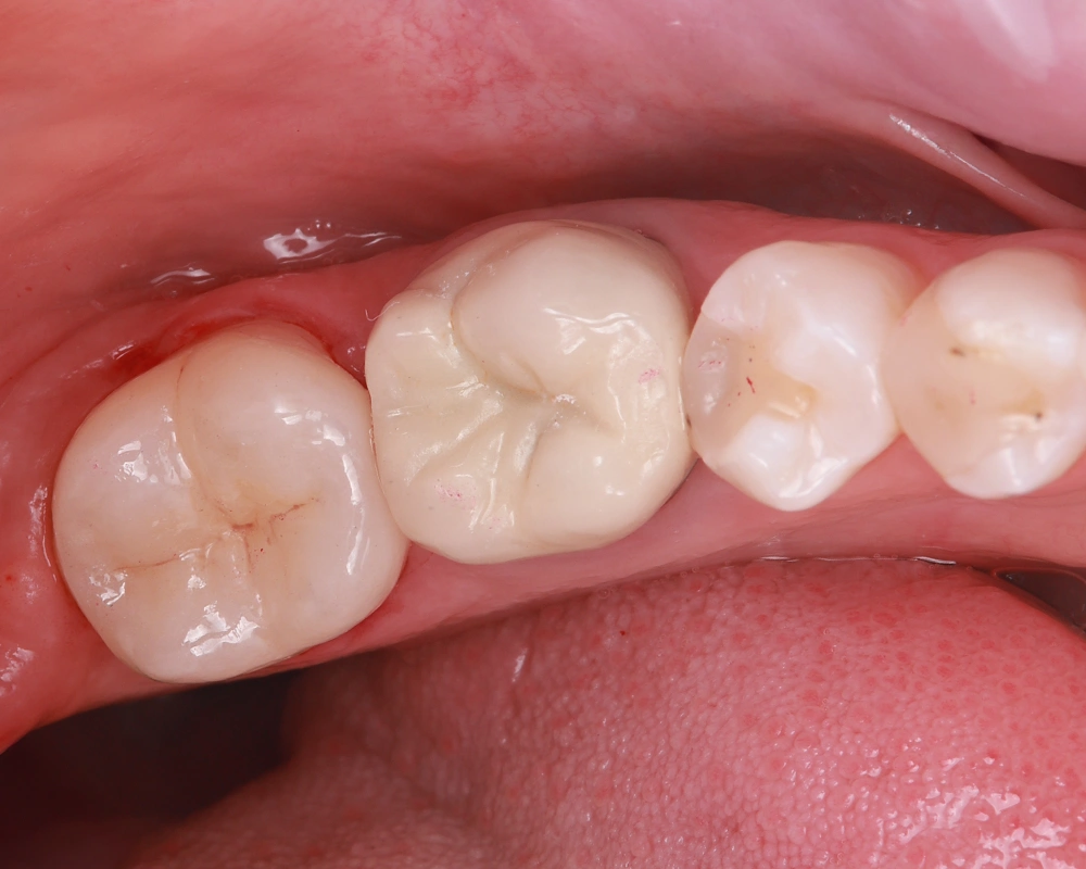 Keramikos uzklotas po 2