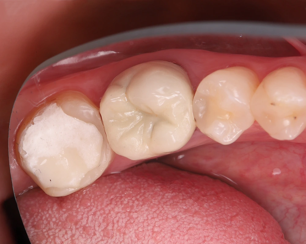 Keramikos uzklotas pries 2