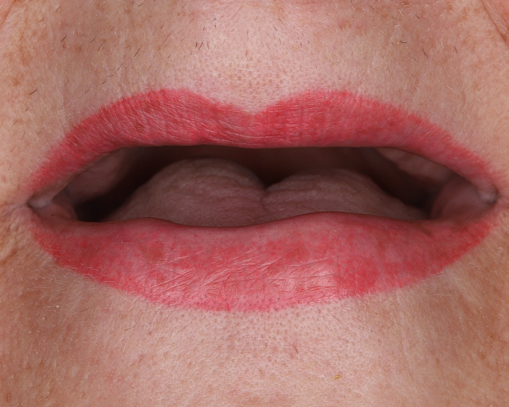 2026-03-25 ALL on 4 abu žandikauliai su nuolatiniais_1_ prieš