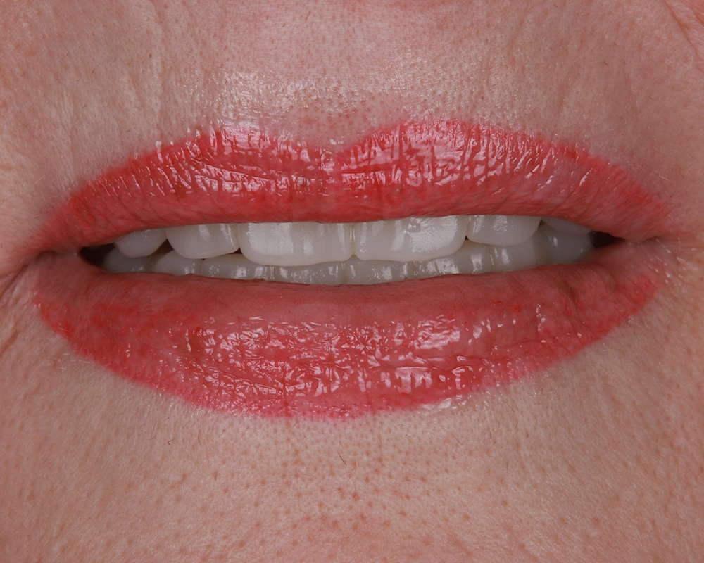 2026-03-25 ALL on 4 abu žandikauliai su nuolatiniais_1_po