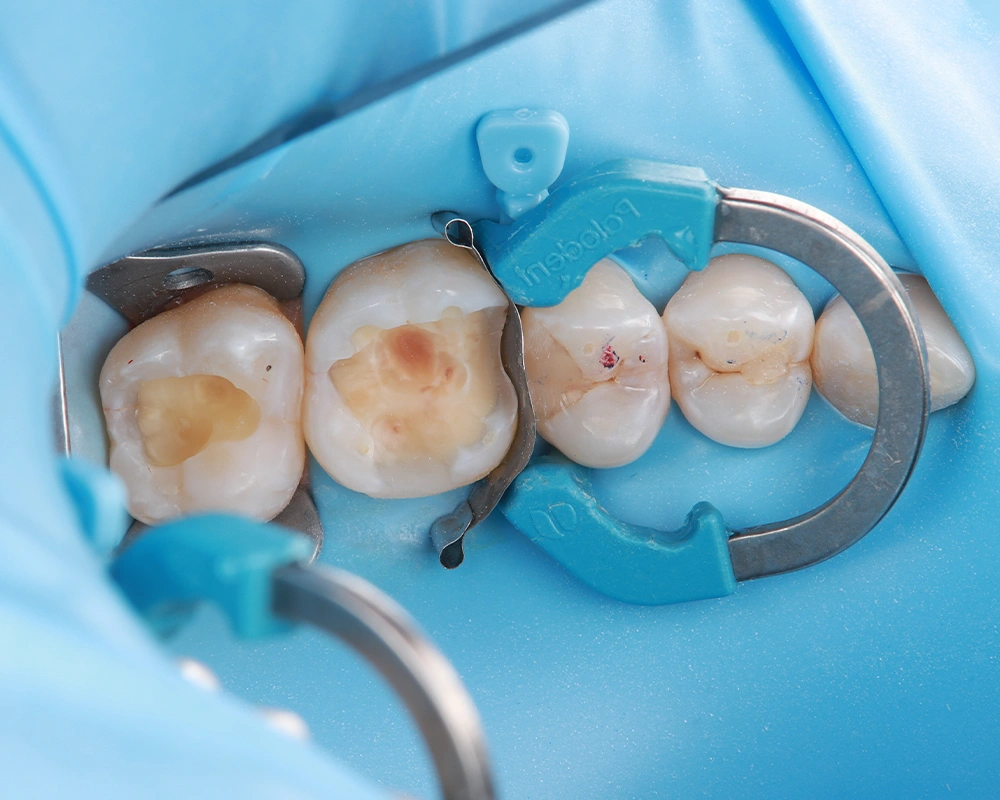 2026-03-25 Funkcinis plombavimas 2_1_ prieš