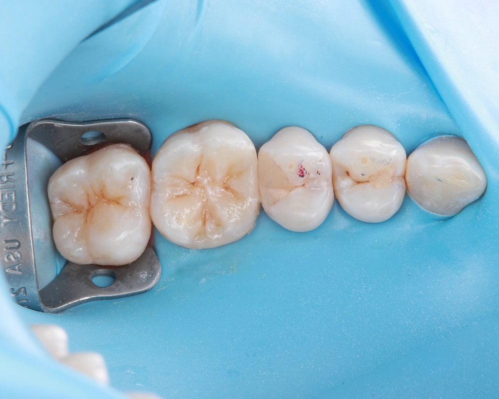 2026-03-25 Funkcinis plombavimas 2_1_po