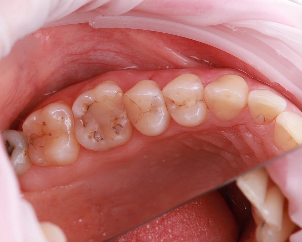 2026-03-25 Funkcinis plombavimas 2_2_ prieš