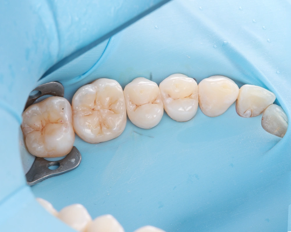 2026-03-25 Funkcinis plombavimas 2_2_po