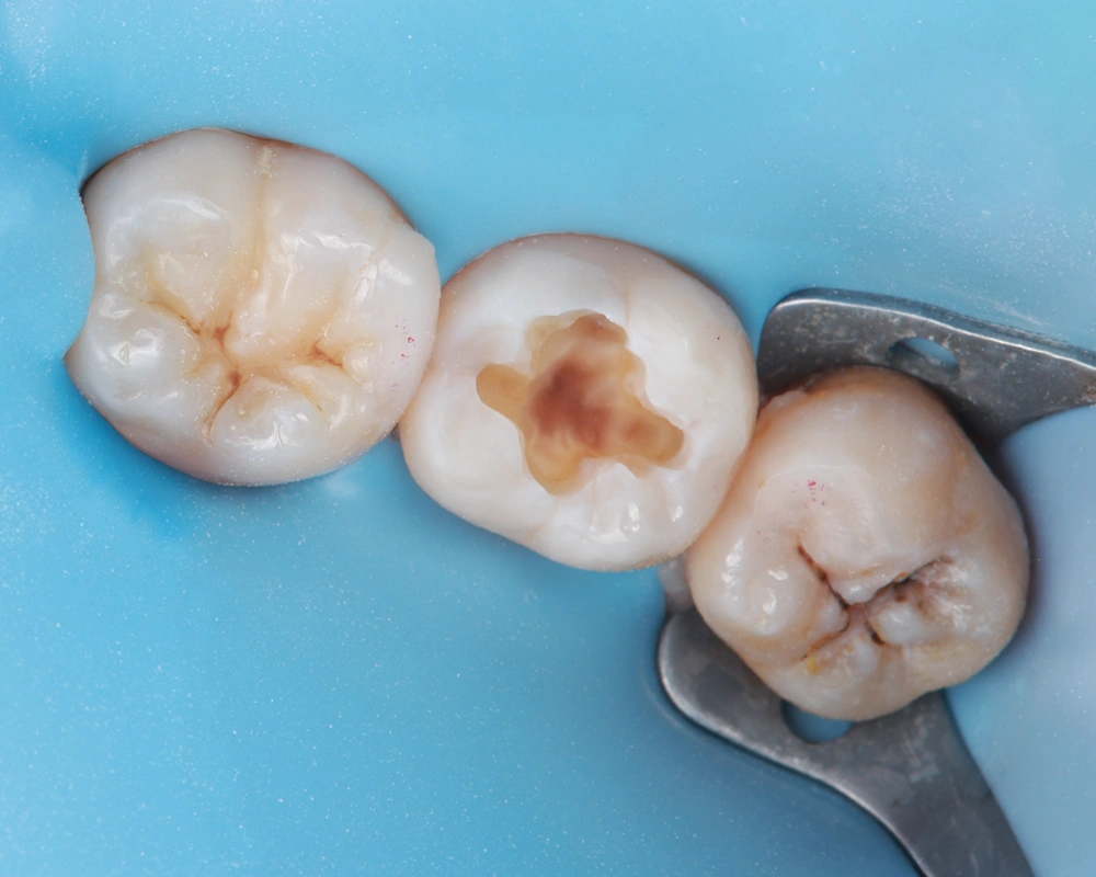 2026-03-25 Funkcinis plombavimas_1_ prieš