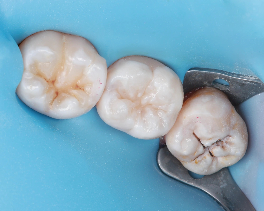 2026-03-25 Funkcinis plombavimas_2_po