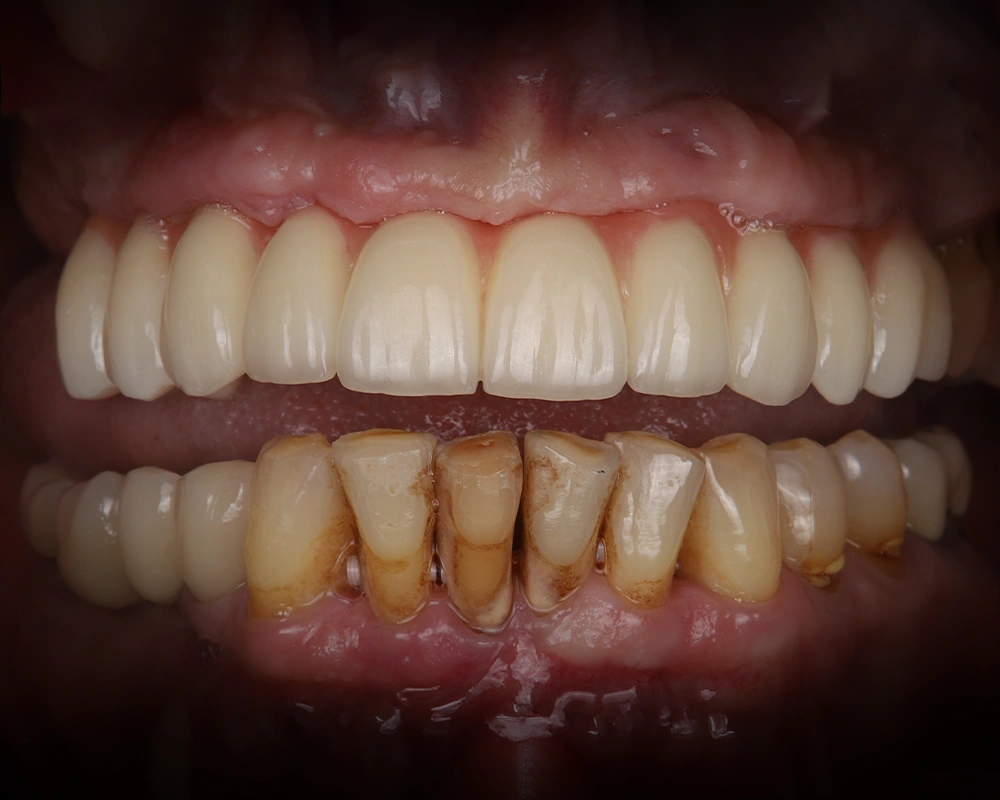 2026-03-25 Tiltas ant implantų_1_ prieš