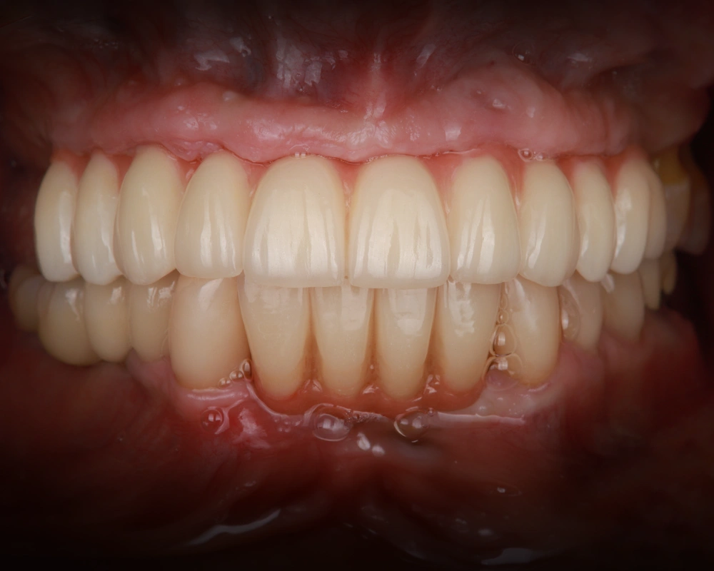 2026-03-25 Tiltas ant implantų_1_po