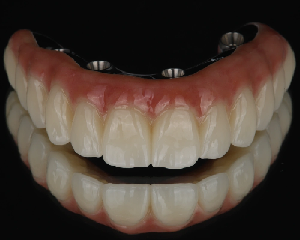 Abiejų žandikaulių dantų atkūrimas ant implantų – 3