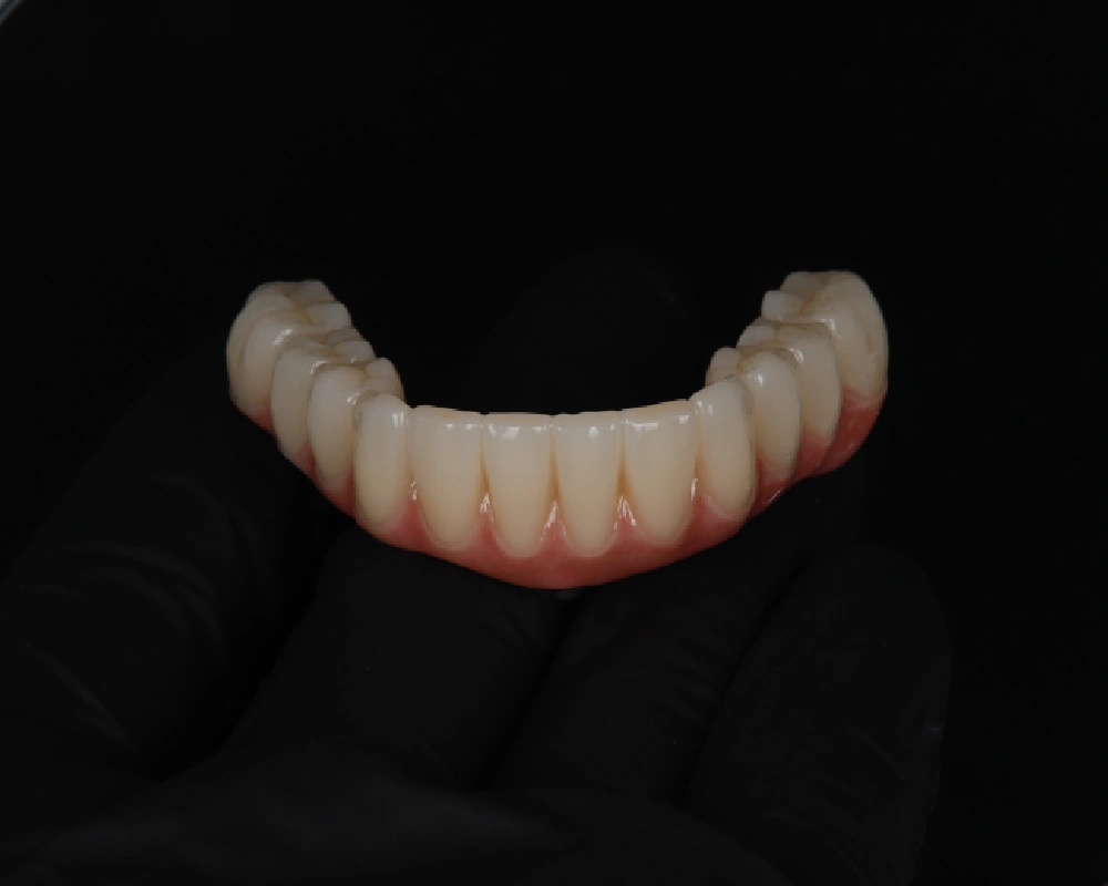 Abiejų žandikaulių dantų atkūrimas ant implantų – 4