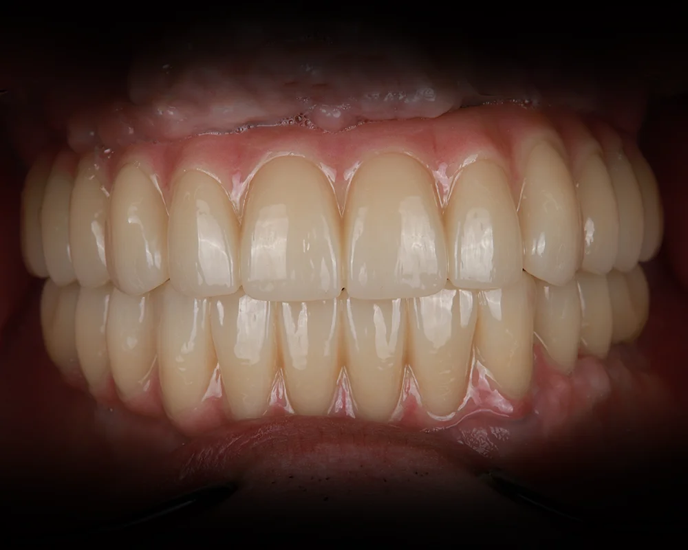 Abiejų žandikaulių dantų atkūrimas ant 4 implantų – 2