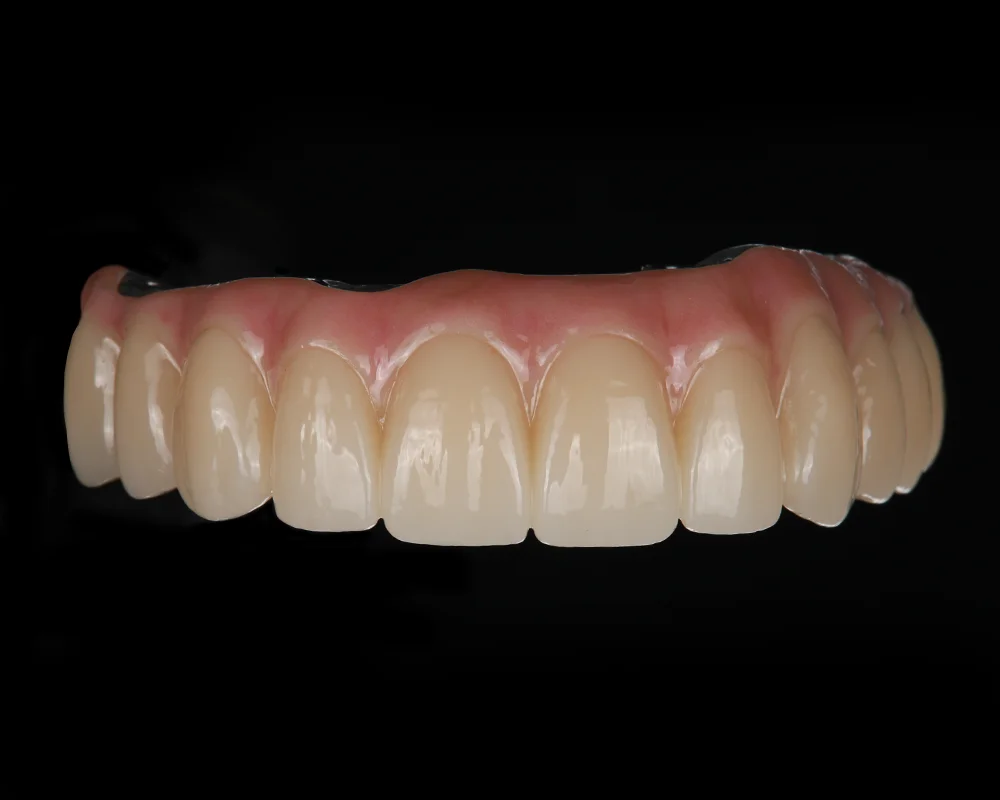 Abiejų žandikaulių dantų atkūrimas ant 4 implantų – 3