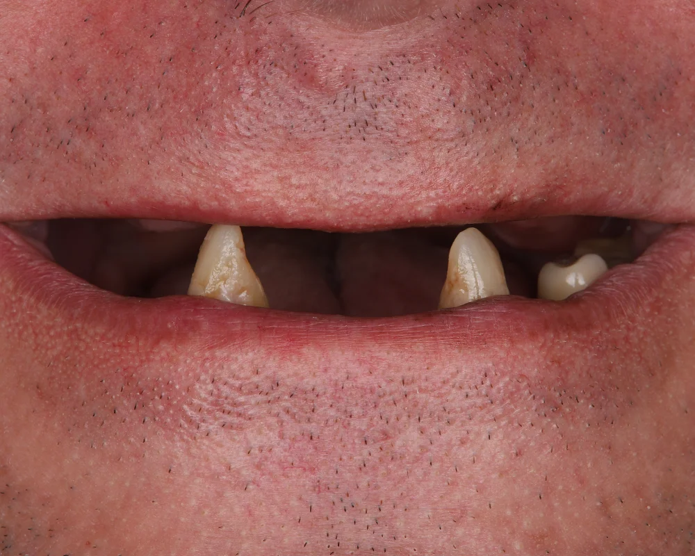 Abiejų žandikaulių dantų atkūrimas ant 4 implantų – 5