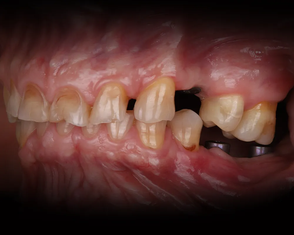Abiejų žandikaulių dantų atkūrimas ant 4 implantų – 11