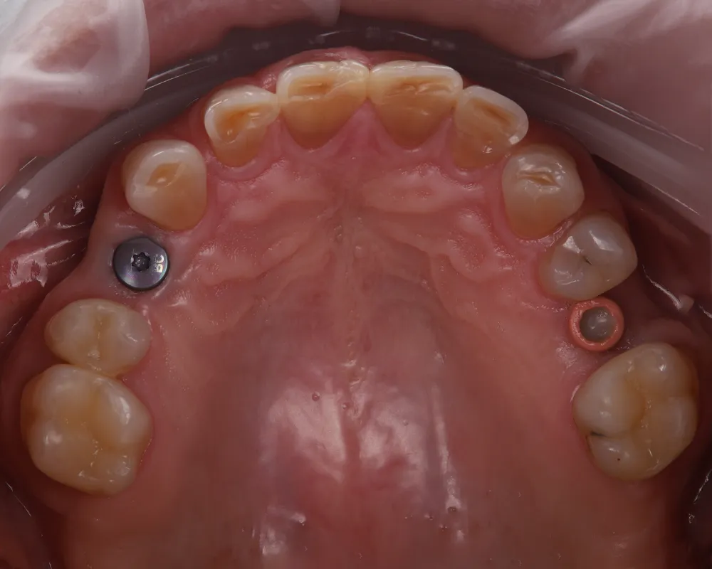 Abiejų žandikaulių dantų atkūrimas ant 4 implantų – 10