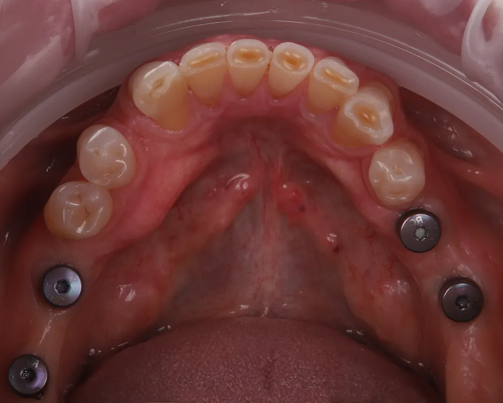 Abiejų žandikaulių dantų atkūrimas ant 4 implantų – 9