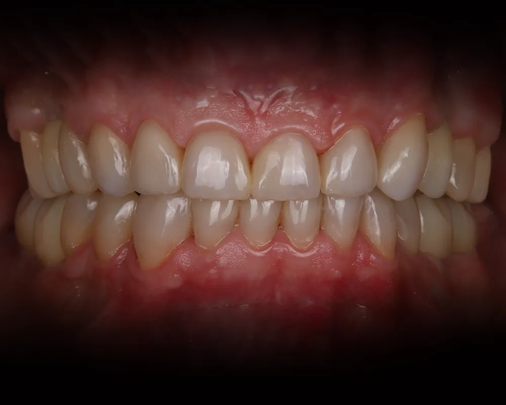 Abiejų žandikaulių dantų atkūrimas ant 4 implantų – 2