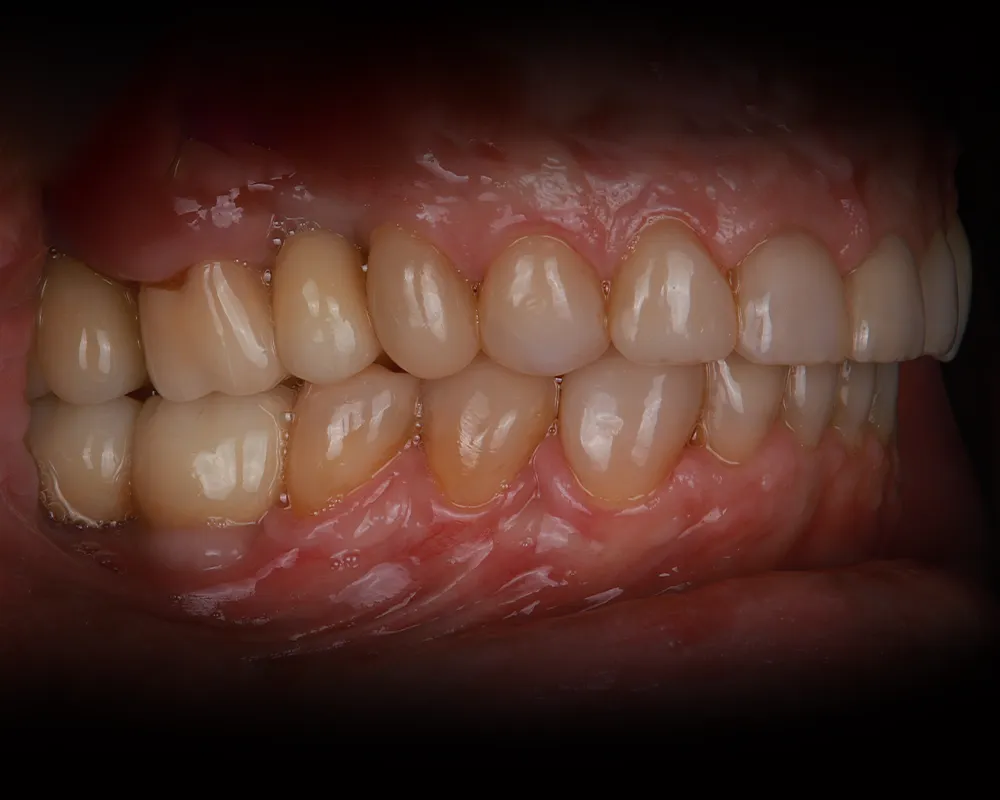 Abiejų žandikaulių dantų atkūrimas ant 4 implantų – 6
