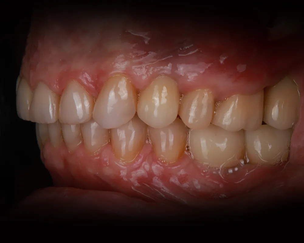 Abiejų žandikaulių dantų atkūrimas ant 4 implantų – 5