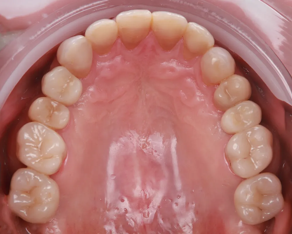 Abiejų žandikaulių dantų atkūrimas ant 4 implantų – 3