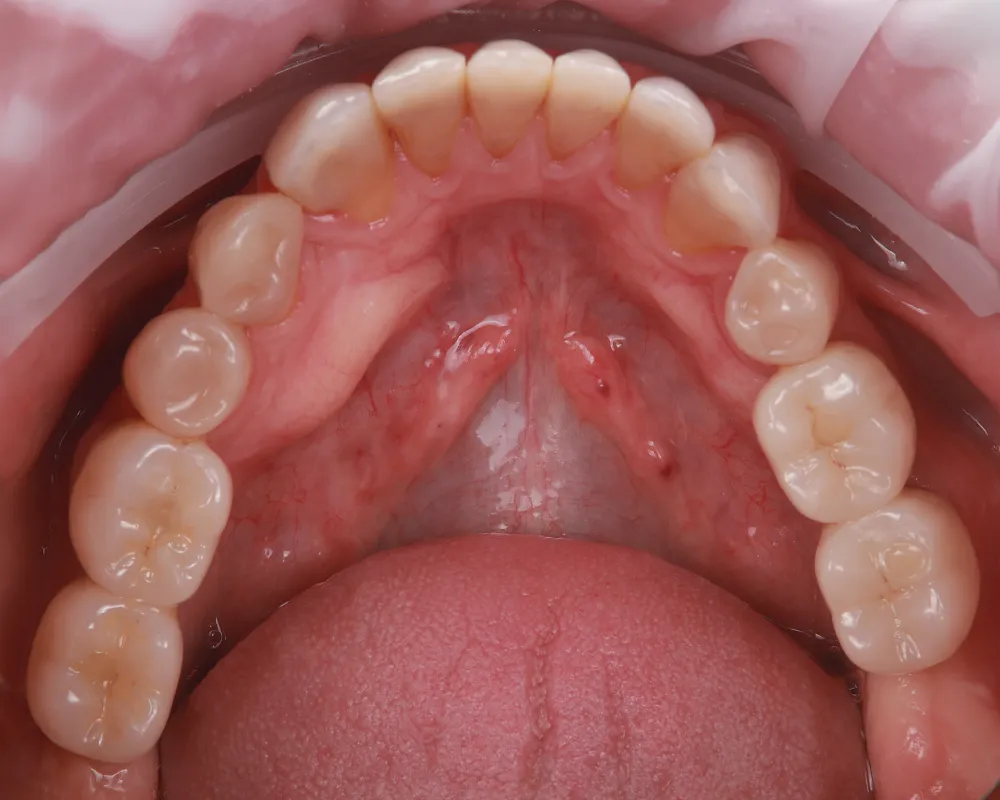 Abiejų žandikaulių dantų atkūrimas ant 4 implantų – 4
