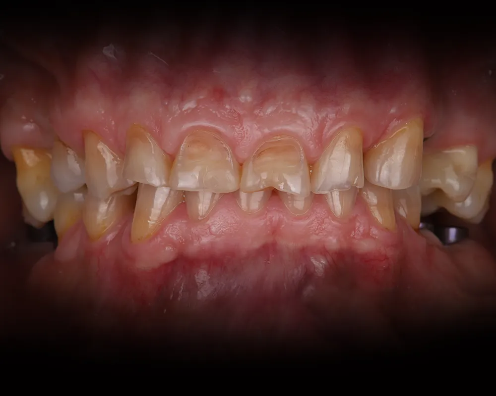 Abiejų žandikaulių dantų atkūrimas ant 4 implantų – 7