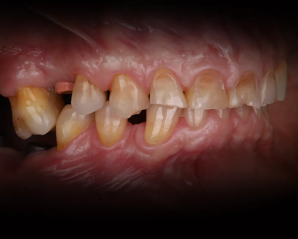 Abiejų žandikaulių dantų atkūrimas ant 4 implantų – 12